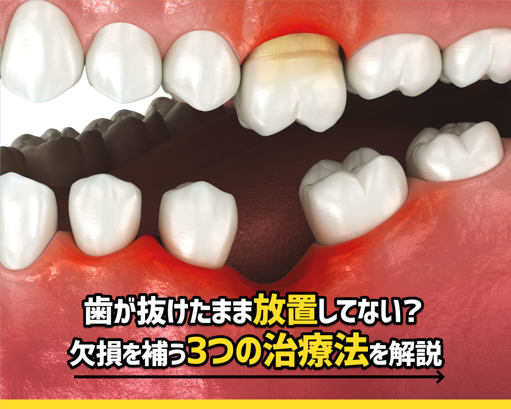  歯が抜けたまま放置してない？欠損を補う3つの治療法を解説