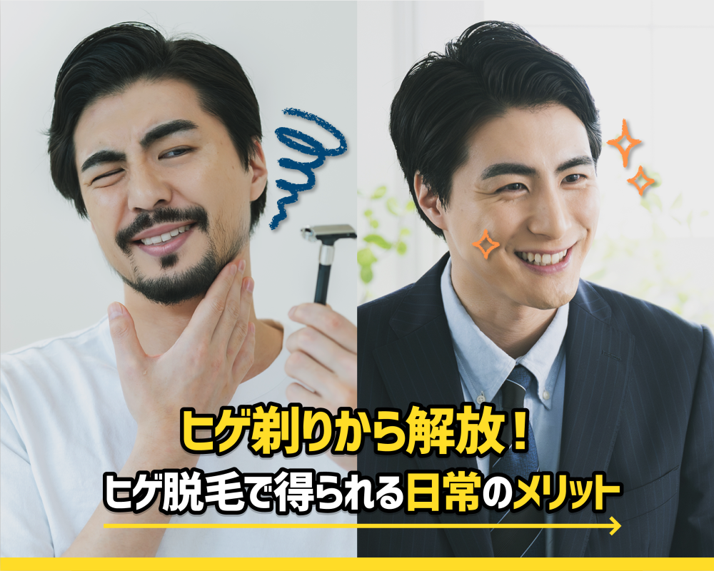  ヒゲ剃りから解放！ヒゲ脱毛で得られる日常のメリット